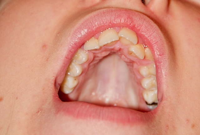 Zähneknirschen, Zähnereiben natürlich und schnell beseitigen